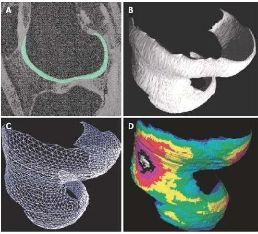 Gambar 2.10: Pemetaan ketebalan tulang rawan femoral.Warna warnimenunjukkan variasi dari ketebalan tulang rawan pada seluruh permukaan femoral(Blumenkrantz dan Majumdar, 2007)