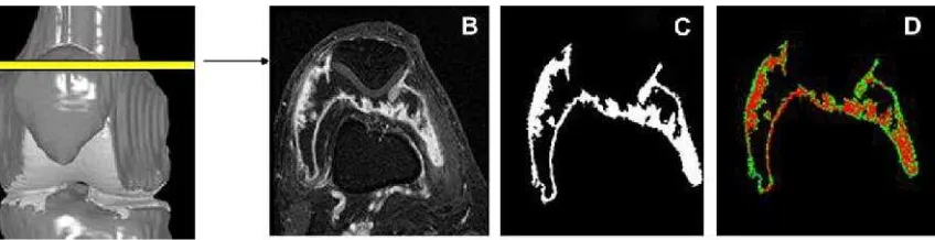 Gambar 2.11: Pengukuran kuantitatif MRI terhadap sinovitisbiru), berupa synovial membranevolume enhancement analysis (SMVL, SMVI, SMVH) (B) Irisan aksial pasca injeksikontras