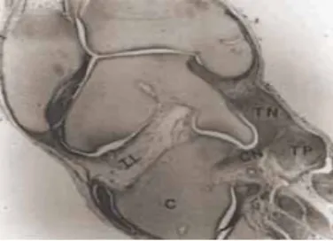 Gambar 2: Tampak ligamen deltoid, tibionavicular dan tendo tibialisposterior  sangat tebal dan menyatu dengan ligamen calcaneonavicular plantaris brevis