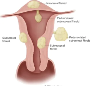 Gambar 1. Jenis-jenis mioma uteri