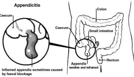 Gambar 3.1. Appendicitis (dengan fecalith)  8