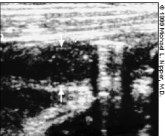 Gambar 3.7.Ultrasonogram pada potongan longitudinal Appendicitis  6