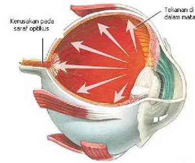 Gambar 2.1 Glaukoma