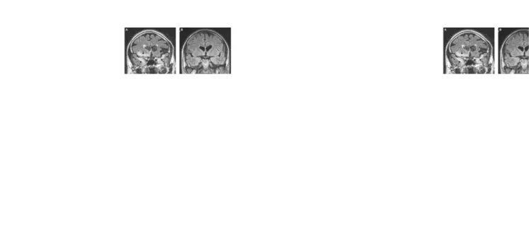 Gambar 10. Brain imaging berupa MRI dari ensefalitis herpes simpleks. A. tampak  keterlibatan bilateral dari lobus temporal medial dan region orbitofrontal kanan (panah).
