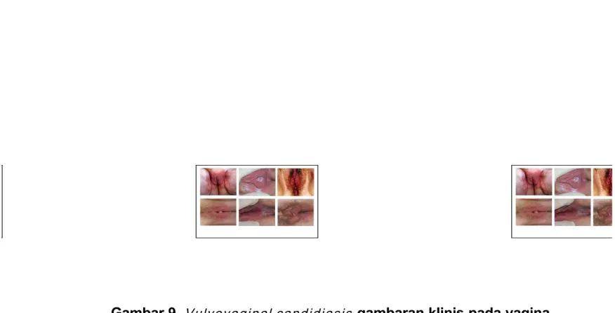 Gambar 9. Vulvovaginal candidiasis  gambaran klinis pada vagina Sumber : www.medscape.com