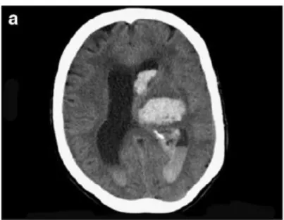 gambar  2 CT-scan intraventrikular hemorrage 3
