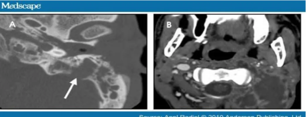 Gambar 4. (A). Potongan axial kontras CT scan memperlihatkan opasifikasi sel udara  mastoid disertai erosi tulang dan proses inflamasi yang agresif