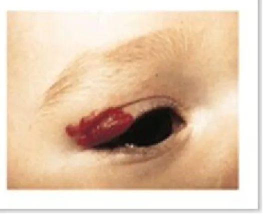 Gambar  Hemangioma periokuler yang kecil pada bayi menyebabkan  astigmatisma. 20