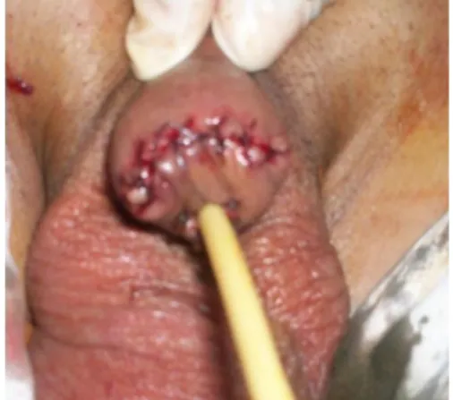 Gambar 5. Post Operasi Penektomi 6) Mohs micrographic surgery (MMS)