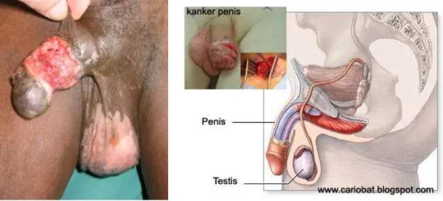 Gambar 1. Kanker Penis