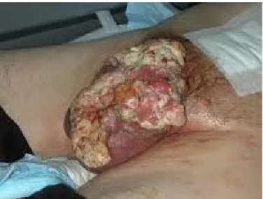 Gambar 3. Kanker penis