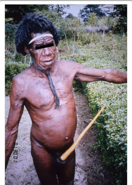 Figure 3 Subcutaneous cysticercosis patient in Papua. Thispatient was often attacked by epileptic seizures [41,43,58-63].