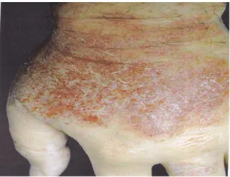 Gambar 5. Dermatitis Kontak Alergik   (Wolff &amp; Johnson, 2009). 