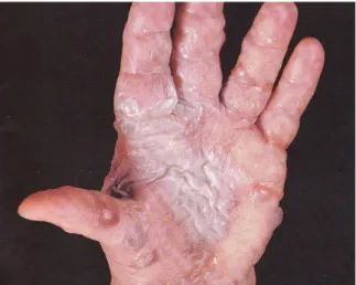 Gambar 3. Dermatitis Kontak Iritan Akut   (Wolff &amp; Johnson, 2009). 