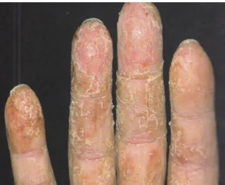 Gambar 4. Dermatitis Kontak Iritan Kronis   (Wolff &amp; Johnson, 2009). 