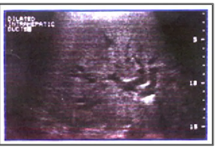 Gambar 3.  CT scan yang menunjukkan dilatasi duktus biliaris (panah hitam) dan dilatasi duktus pankreatikus (panah putih), dimana keduanya terisi oleh musin
