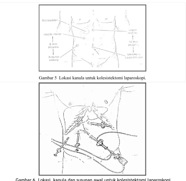 Gambar 5  Lokasi kanula untuk kolesistektomi laparoskopi.