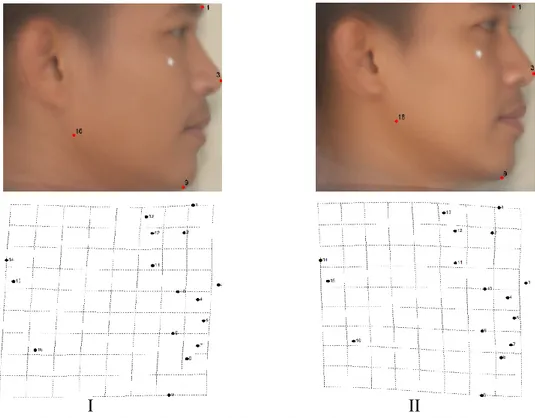 Gambar 7 Tipe I dan II wajah samping pria dengan grid deformasinya 