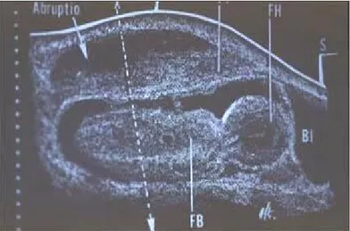 Gambar 2. 3 Ultrasonografi kasus solusio plasenta.