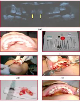 Gambar  1.  Proses  pengambilan  gigi  impaksi  kaninus  maksila  bilateral.    (A)  Ortho  Panoramic  Graft  (OPG)  menunjukkan  posisi  gigi  impaksi  kaninus  maksila  bilateral  (tanda  panah)