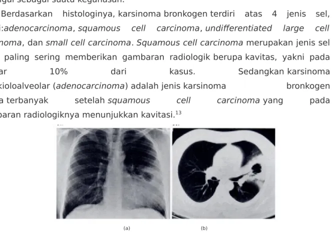 Gambar   10. Bronchioloalveolar   carcinoma pada   pria   39   tahun   dengan   sputum darah   dan   nyeri   dada   pleuritik