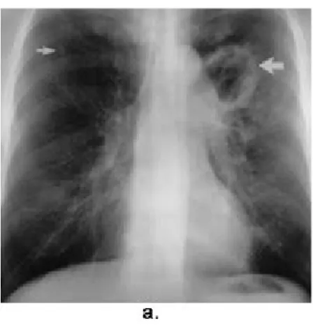 Gambar 11. Distribusi atipic postprimer TB pada seorang pria 62 tahun. (a) Foto thorax menunjukkan massa kavitas 5 cm dengan dinding tebal tidak teratur (panah