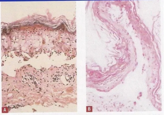 Gambar 6. A tampak nekrosis eosinofilik di dermis pada fase puncak, dengan sedikit  inflamasi  di  daerah  dermis