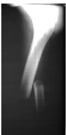 Gambar 5.1. Fraktur batang femur