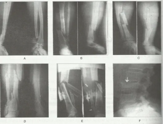 Gambar 2.3. Beberapa gambaran radiologik konfigurasi fraktur  (A)Transversal, (B)Oblik, (C)Segmental, (D)Spiral dan segmental, 