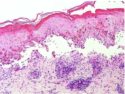 Gambar  2  Histopatologi SJS/TEN. Terdapat keratinosit apoptotik multipel pada seluruh  ketebalan epidermis, dan pemisahan subepidermal membentuk bulla