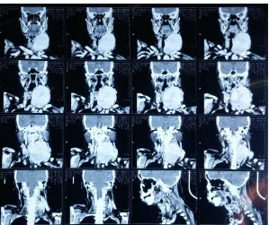 Figure 2. A computed tomography (CT) scan of the neck showed an 8-9 cm mass in the     