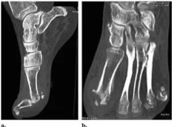 Gambar 3. Osteomyelitis pada pria berusia 84 tahun,  foto CT Scantampak sagital (a) dan axial (b) memperlihatkan fraktur pada tulang metatarsal dan sesamoid