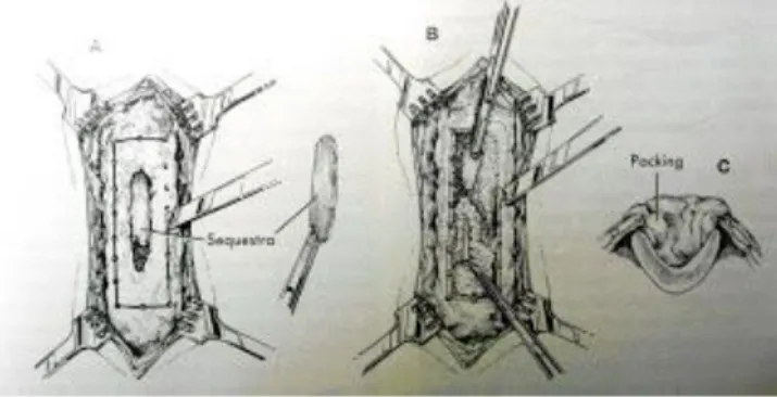 Gambar 4. Teknik sekuestrektomi dan kuretase. A. Daerah tulang yang terinfeksi dibuka dan sequestrum dibuang; 