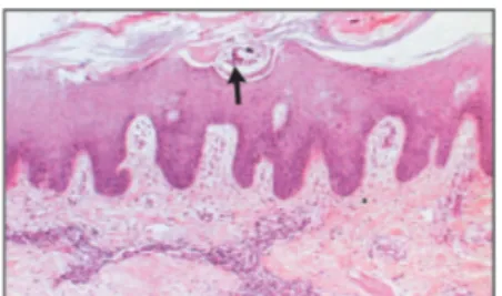 Gambar 11. Sarcoptes scabiei dalam epidermis (panah) dengan pewarnaan H.E *