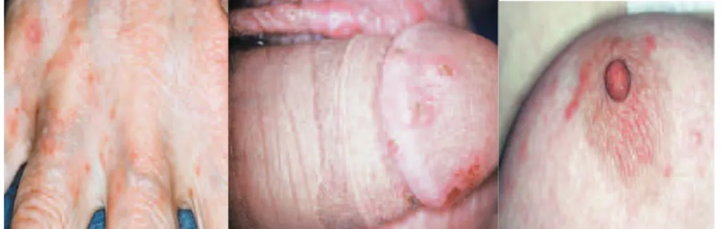 Gambar 3. Lesi pada sela jari, penis, dan areola mammae * 