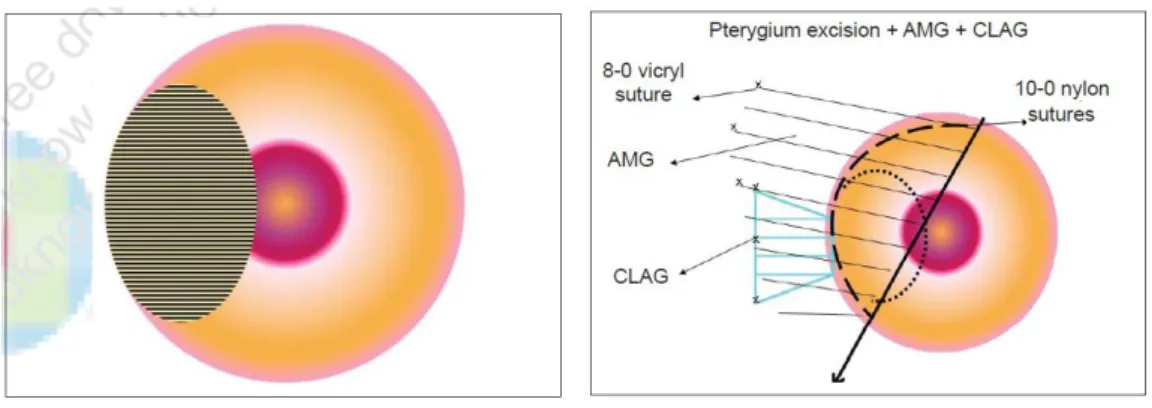Gambar 13.  Gambar skema pterygium yang  melibatkan kornea 