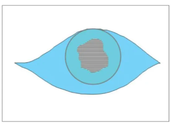 Gambar 4. Digram skematik membran  amnion patch pada PED. AMG –  Amniotic membrane graft  