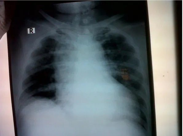 Gambar 2.1 Foto Thorax  Kesan: Bronkhitis, kardiomegali 