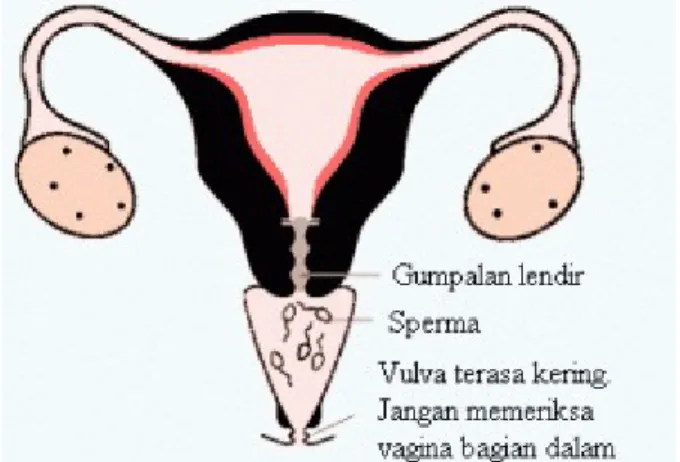 Gambar 6.Pola Dasar Tidak Subur (PDTS).Keadaan kering pada vulva.Sel-sel sperma tidak mungkin memasuki rahim karena leher rahim tertutup oleh gumpalan lendir yang kental dan