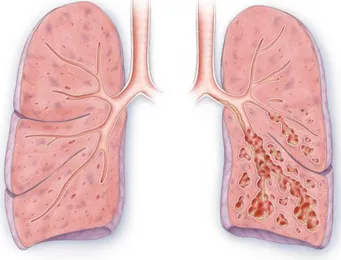 Gambar  2.  Perbedaan  gambaran  paru-paru  normal  dengan  paru-paru pengidap bronkiektasis