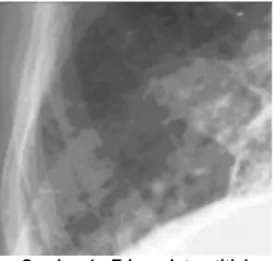 Foto thoraks Pulmonary edema secara khas didiagnosa dengan X-ray dada. Radiograph (X- (X-ray) dada yang normal terdiri dari area putih terpusat yang menyinggung jantung dan 