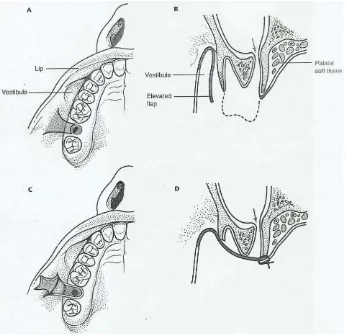 Gambar 11. ( E) Bukal flap telah menutupi prosssus alveolaris dan disuturing ke mukosa palatal untuk menutup traktus fistula