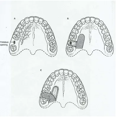 Gambar 12. Penutupan fistula oroantral. (A) ilustrasi traktus fistula oroantral di prosessus alveolaris gigi molar kedua kanan atas yang akan ditutup dengan rotasi palatal flap