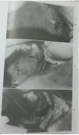 Gambar 13. (D) Fistula oroantral yang luas pada maksila kiri yang terjadi setelah pencabutan gigi molar kedua 