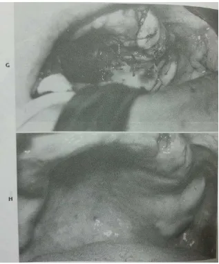 Gambar 14. (G) Palatal flap dirotasikan secara lateral dan dijahi pada posisinya. Krusakan tulang sudah tertuutp secara sempurna
