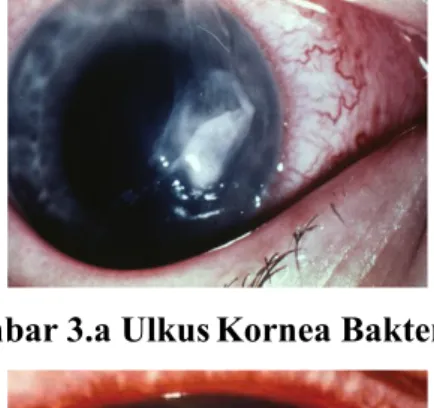 Gambar 3.a Ulkus Kornea Bakterialis