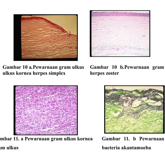 Gambar 10 a.Pewarnaan gram ulkus Gambar   10   b.Pewarnaan   gram ulkus kornea herpes simplex herpes zoster