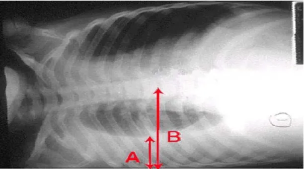 Gambar 6. Tanda panah A menunjukkan cairan dari efusi pleurapada cavum pleura kanan.
