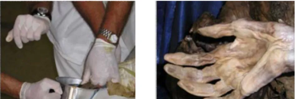 Gambar 12. Pada foto pertama tampak Prosedur Hand boiling dan pada foto kedua  tampak  foto sidik jari setelah Hand boiling