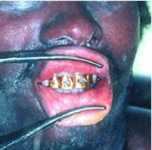 Gambar 15. Pemeriksaan gigi : pada gigi emas terdapat inisial korban 16 